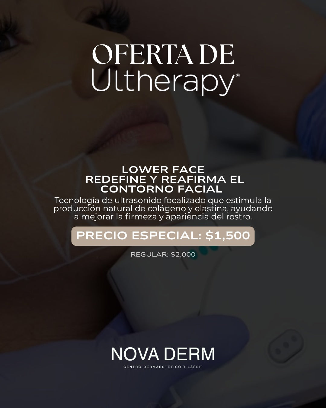 Flash Sale Ultherapy Lower face